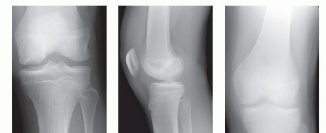Illustration 14 for Dissecans of the Knee: What's the Difference – OCD vs. AVN?