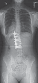 Illustration 54 for Mastering Anterior Interbody Arthrodesis with Instrumentation for Scoliosis