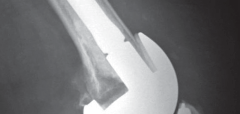 Illustration 25 for Solving Severe Bone Loss: Tantalum for Patellar Reconstruction