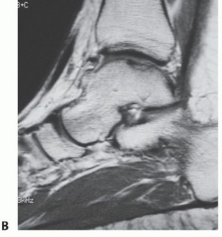 Illustration 2 for Restore Damaged Cartilage with Autologous Chondrocyte Transplantation