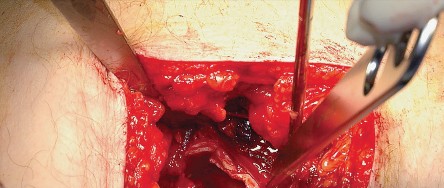 Illustration 35 for Unlock the Figure Posterior Approach to the Hip