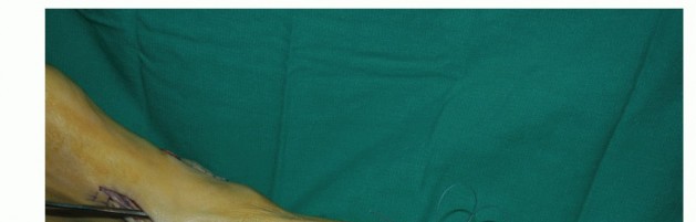 Illustration 34 for Restore Movement: Tendon Transfer for Common Peroneal Nerve Foot Drop