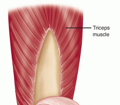Illustration 29 for Surgical Approaches to Shoulder & Elbow: Pearls and Pitfalls