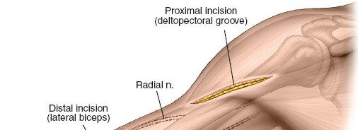 Illustration of minimally invasive anterior - Dr. Mohammed Hutaif