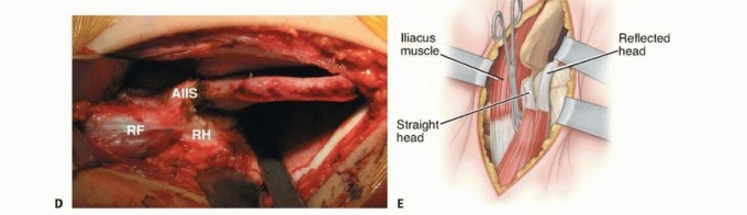 Illustration 12 for Mastering Anterior Open Reduction for Developmentally Dislocated Hip