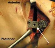 Illustration 38 for Guide Pin Assembly: Key to Flawless Upper Tibial Osteotomy