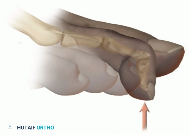 Illustration 3 for Hammer Toe Correction: Understanding the Extensor Digitorum Longus