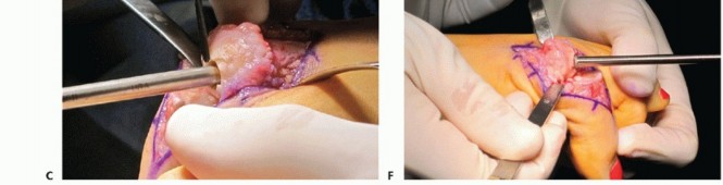 Illustration 25 for End Articular Cartilage Loss: Arthrosurface HemiCAP Resurfacing