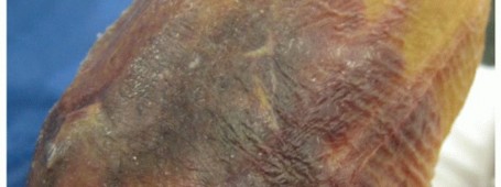 Illustration 2 for Distal Humeral Fractures: When Is Elbow Replacement the Best Option?