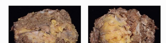 Illustration 59 for Sacral Tumor Surgery: Safeguarding Bowel & Bladder Control