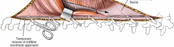 Illustration 400 for Approach to the Lumbar Spine: Mastering Techniques & Anatomy
