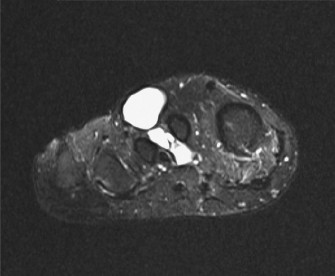 Illustration 3 for Unraveling Foot & Ankle Lumps: Is it Clear Cell Sarcoma?