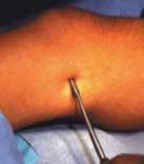 Illustration 3 for Percutaneous Epiphysiodesis: Precisely Closing the Third of the Physis