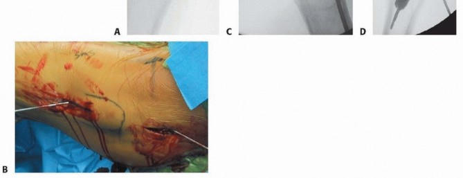 Illustration 22 for Is a Sliding Hip Screw Best for Your Femoral Neck Fracture?