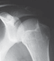 Illustration 3 for Regain Stability: Anterior Shoulder Instability Arthroscopic Fix