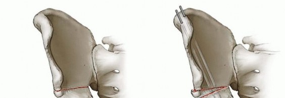 Triple Innominate Osteotomy: Restoring Hip Coverage & Stability