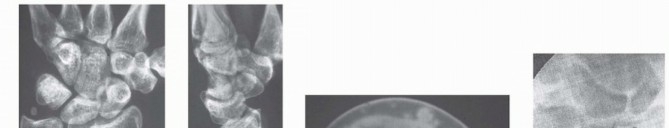 Illustration 27 for Precision Correction for Distal Radius Malunion