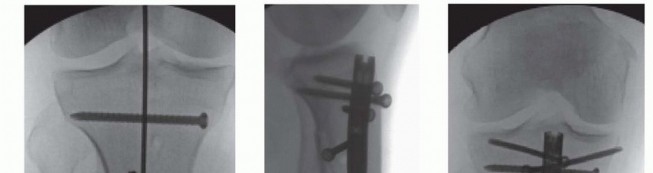 Illustration 42 for Optimizing Intramedullary Nailing for Tibial Shaft Fractures