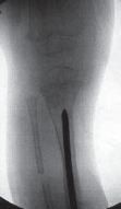 Illustration 18 for Solving Congenital Pseudarthrosis: Tibia with the Williams Rod