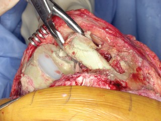 Illustration 42 for PROSTALAC Articulating Spacer: Treat Infected Knees, Regain Mobility