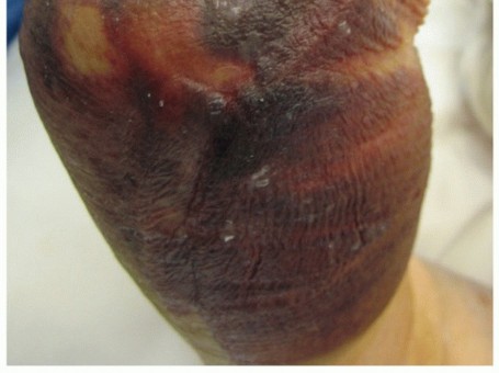 Illustration 3 for Distal Humeral Fractures: When Is Elbow Replacement the Best Option?