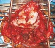 Illustration 14 for Cervical Fusion: The Line is Drawn for Lasting Stability