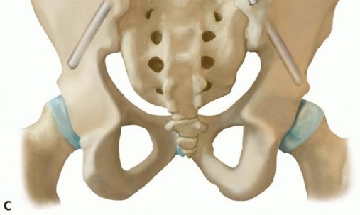 Illustration 23 for Duchenne Muscular Dystrophy: Is Spinal Fusion the Answer?