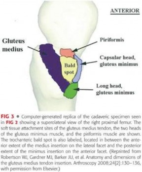 Illustration 19 for Periarticular Arthroscopy: Addressing Medius & Minimus Tears