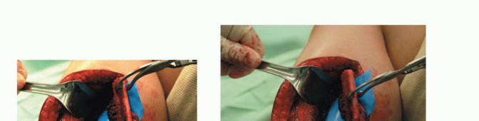 Illustration 27 for Free Vascularized Fibular Grafts: Solving Complex Bone Defects