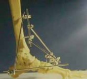 Illustration 39 for Talar Neck Fracture Treatment: Optimizing Recovery with ORIF