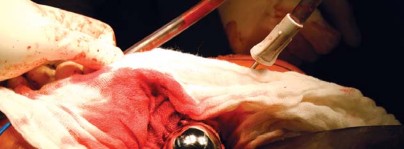 Illustration 69 for Metal on Metal Resurfacing: Enhanced Posterior Soft Tissue Repair