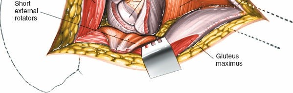 Illustration 188 for Unlocking Every Aspect of the Hip's Surgical Approaches