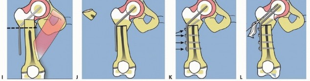 Illustration 26 for Treatment for Congenital Femoral Deficiency: What You Need to Know