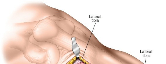 Illustration 53 for Surgical Access: Mastering the Tibia's Surface & Fibula Approaches