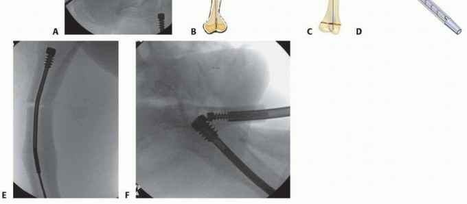 Illustration 27 for Less Pain, More Function: Fassier-Duval Nailing for Osteogenesis Imperfecta