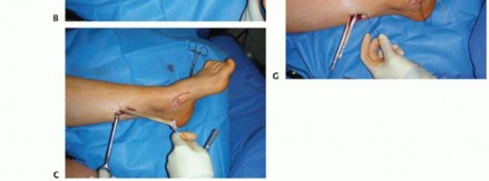 Illustration 20 for How Achilles Tendon Lengthening Fixes Equinocavovarus Foot