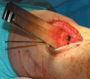 Illustration 31 for Guide Pin Assembly: Key to Flawless Upper Tibial Osteotomy