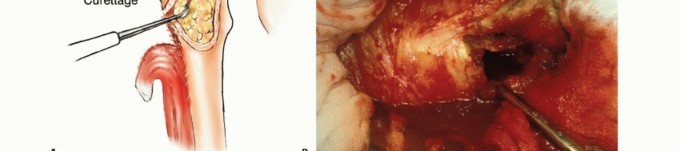 Illustration 13 for Mastering Femoral Metastases: Optimal Function for Femoris & Vastus
