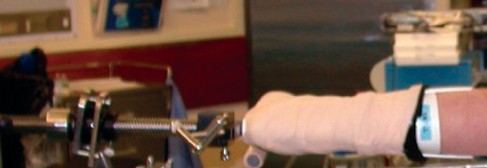 Illustration 14 for Essential Hip Arthroscopy Techniques for Optimal Outcomes