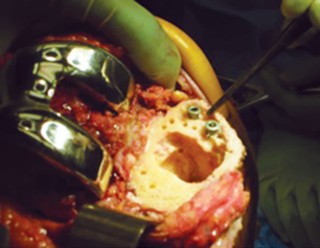 Illustration 13 for Uncemented Stems in Revision: A Guide to Success & Pitfalls