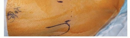 Illustration 17 for Hip Arthroscopy: Your Minimally Invasive Solution for Hip Pain