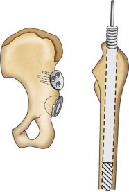 Illustration 127 for Successful Total Hip Replacement in Developmental Dysplasia