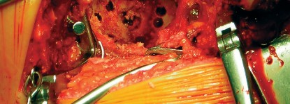 Illustration 61 for Cemented Component Longevity: The Critical Margin of the Acetabulum