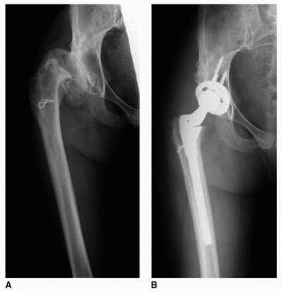 Illustration 3 for Overcoming Proximal Femoral Deformity in THA: Key Strategies