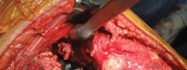 Illustration 40 for Optimizing Arthroplasty in Acute Fractures: Octopus System