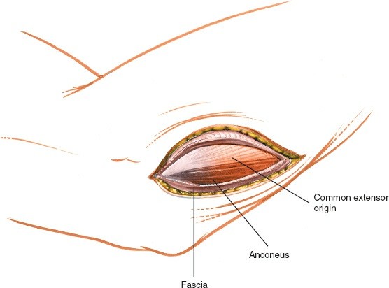 Illustration 94 for Mastering Elbow Approaches: Applied Surgical Anatomy for Precision
