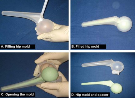 Illustration 10 for Optimizing Outcomes: Two Stage Revision for Infected Total Hip Replacement