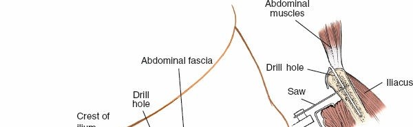 Illustration 25 for Pelvis & Acetabulum Approaches: Unlocking the Posterior Superior Iliac