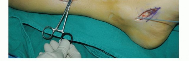 Illustration 40 for Foot Drop Surgery: How a Pin or Drill Elevates Tendon Transfer