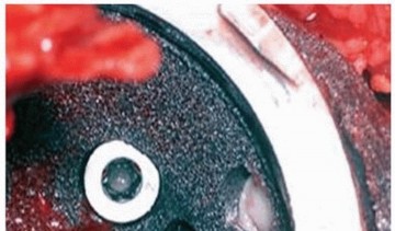 Illustration 10 for Uncemented Acetabular Component: Augments & Cup-Cages for Bone Loss